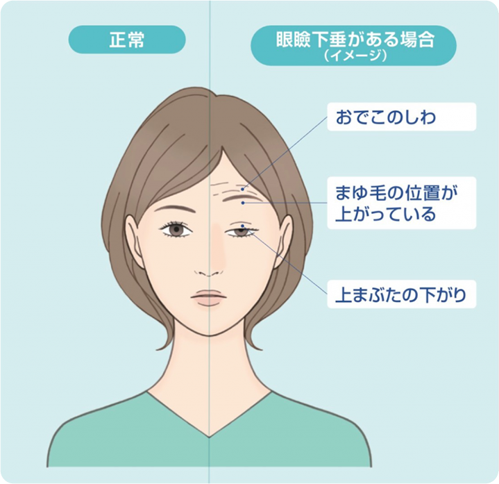 眼瞼下垂