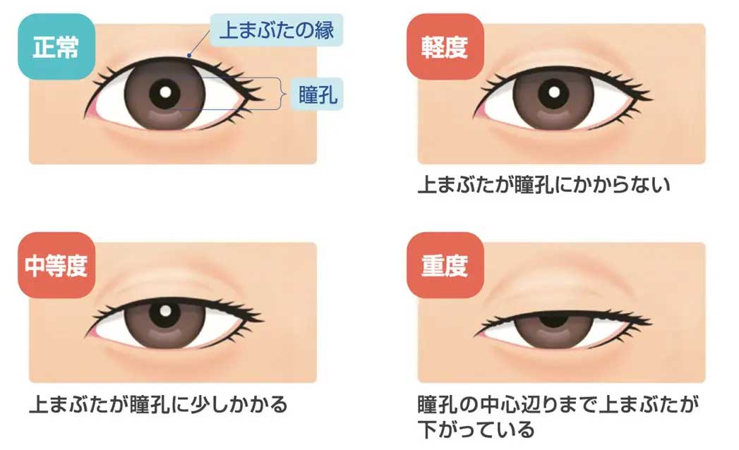 下垂のしくみと程度